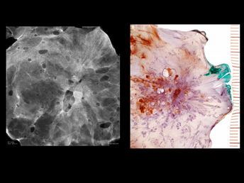 Juvenile Papillomatosis (Swiss Cheese Disease) of the Breast
