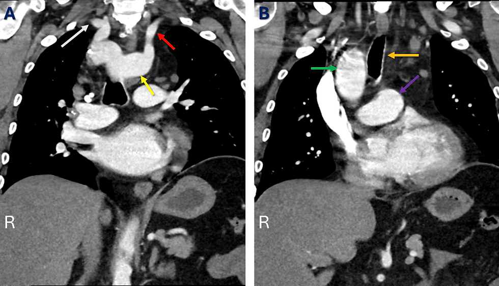 Kommerell Diverticulum Coronal CT Scan