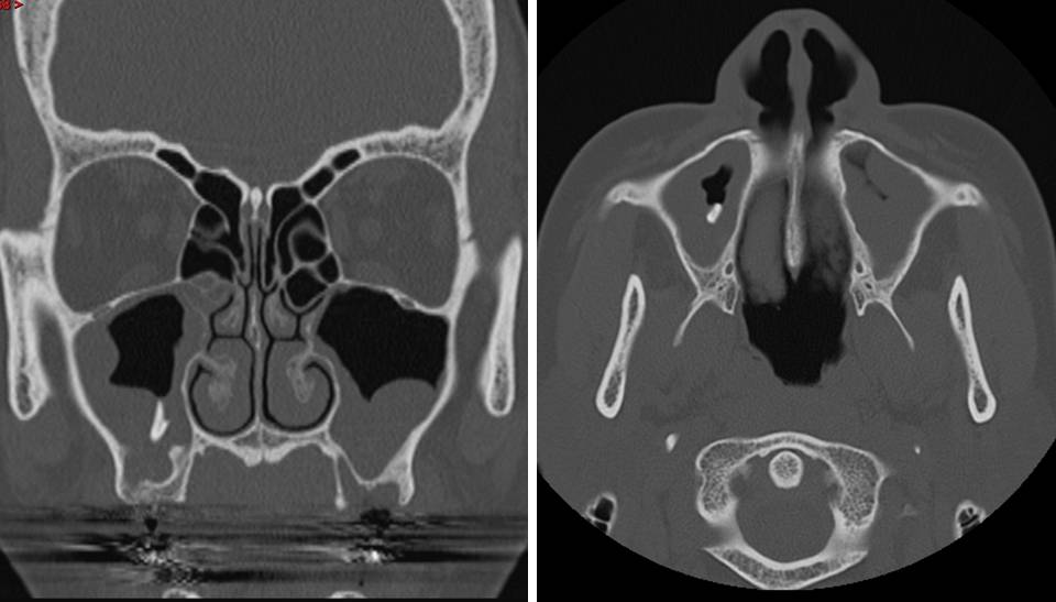 Tooth Root in the Maxillary Sinus