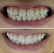 Transformação de sorriso de menina em So