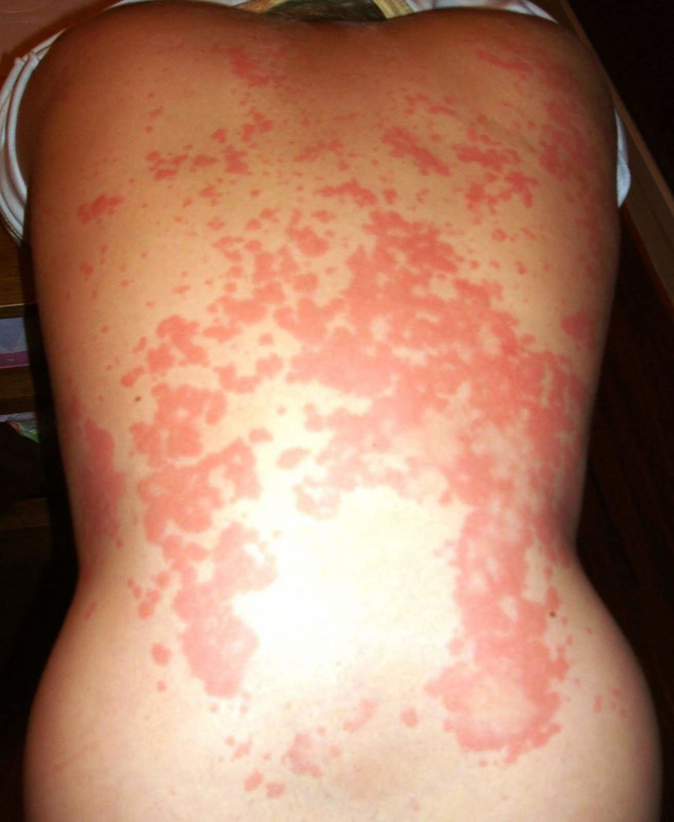 Alteraciones vasculares.