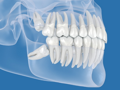 Radiografia odontológica mostrando dentes do siso em diferentes estágios de desenvolvimento na arcada dentária