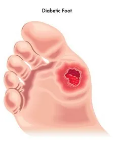 Diabetic Ulcer.webp