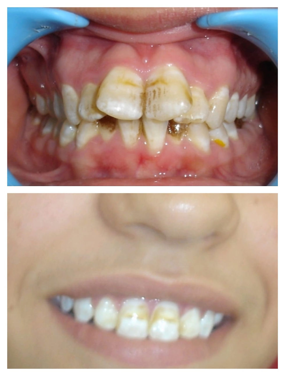 Orthodontics_Nayra Dental Care (8)