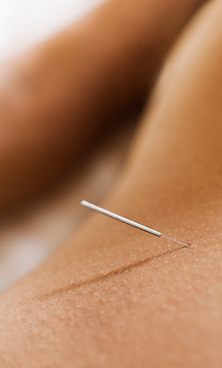 Woman Receiving Acupuncture