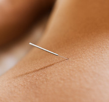 Kiné Ixelles, Flagey, Bruxelles, Dry Needling, triggers point, physiothérapie
