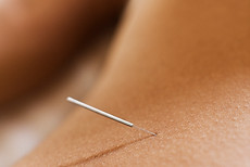 Acupuncture Therapy Close-up