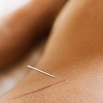 Woman Receiving Acupuncture