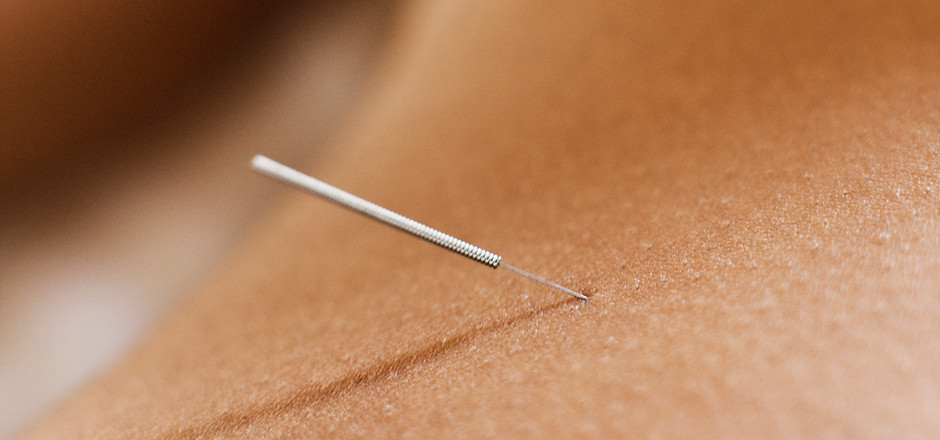 Acupuncture, Acupuncture needle