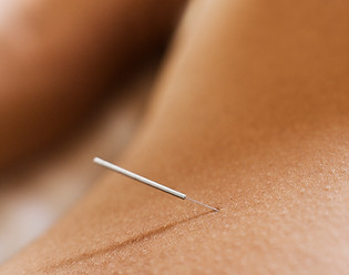 Primo piano dell'ago per agopuntura