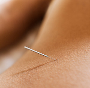 Woman Receiving Acupuncture