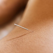 Acupuncture