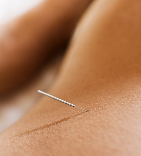 Akupunkturtherapie Nahaufnahme