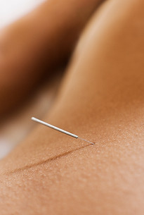 Woman Receiving Acupuncture