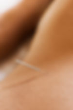 Woman Receiving Acupuncture