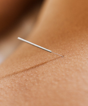 Woman Receiving Acupuncture