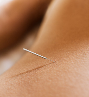 Woman Receiving Acupuncture