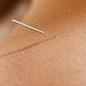 Woman Receiving Acupuncture