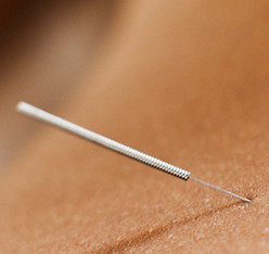 Acupuntura