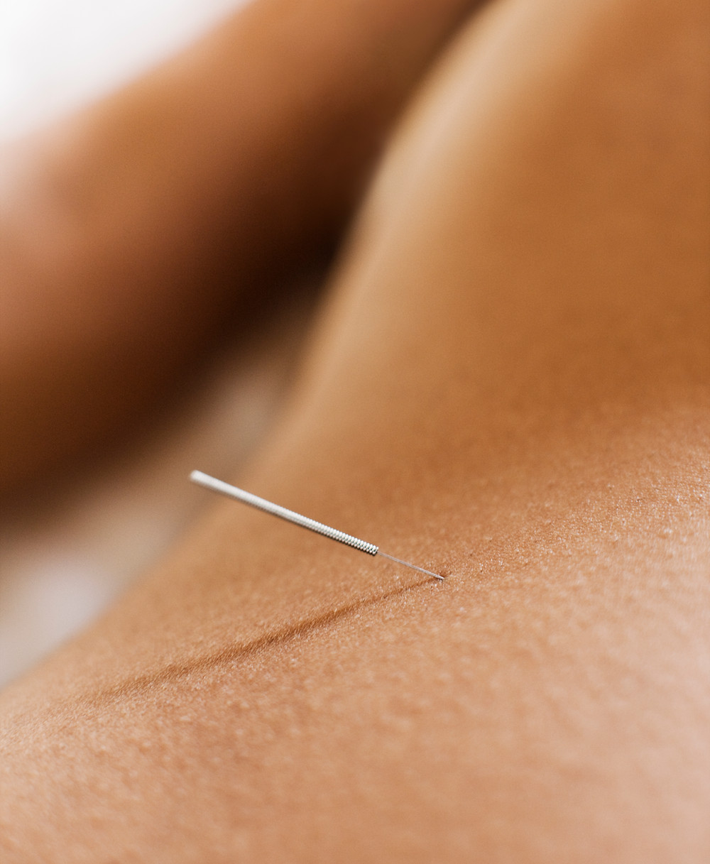 acupuncture involves the insertion of needles on specific acupoints