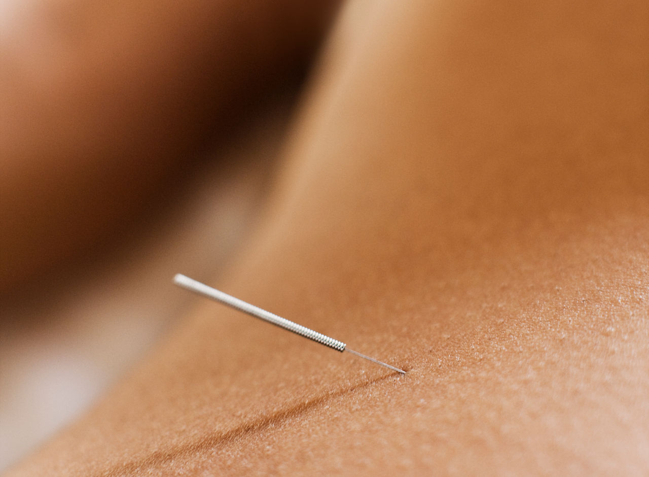 Woman Receiving Acupuncture