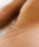 鍼灸針のクローズアップ