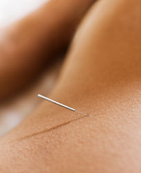 Woman Receiving Acupuncture