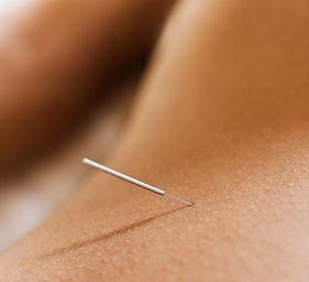 Woman Receiving Acupuncture