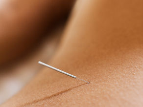 Is Electroacupuncture What You Need? Acupuncture for pain relief at Olivine Clinic Poundbury