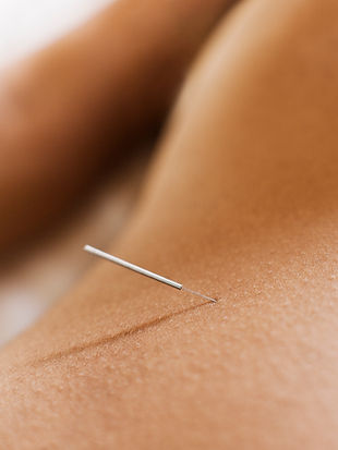 acupuncture den haag