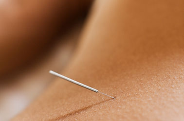 Acupuncture Needle Closeup