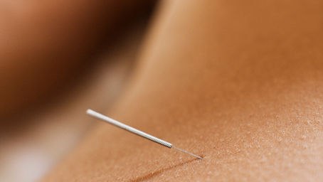 The Art of Rejuvenation: Exploring Cosmetic Acupuncture Therapy vs. Botox