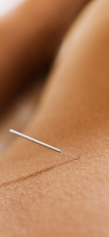 Woman Receiving Acupuncture