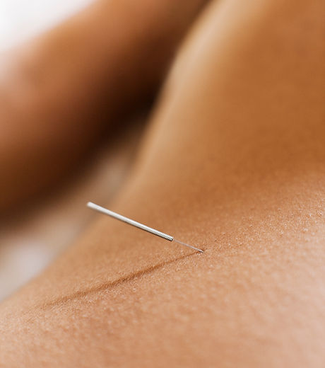 Woman Receiving Acupuncture