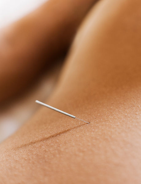 Woman Receiving Acupuncture