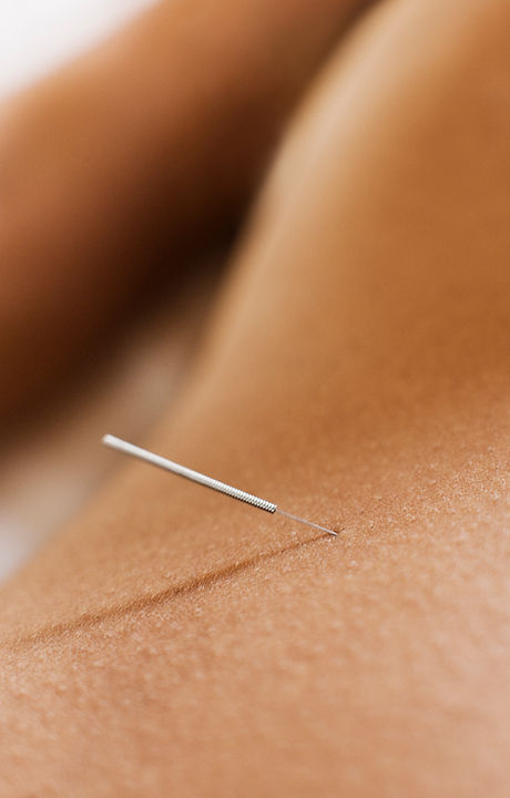 Woman Receiving Acupuncture