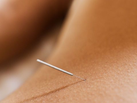 Acupuncture Channels and Fascia