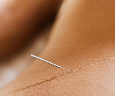 Woman Receiving Acupuncture
