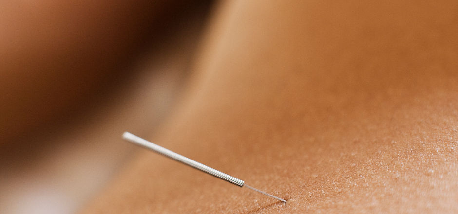 Woman Receiving Acupuncture