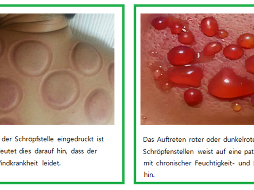                Schröpfen Therapie -                                                             Prüfung von Schröpfen-Markierungen     