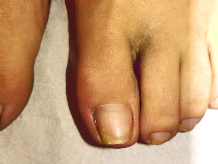 Green Nail pseudomonas Harley Medical Foot and Nail Clinic Nail Surgery Specialist before