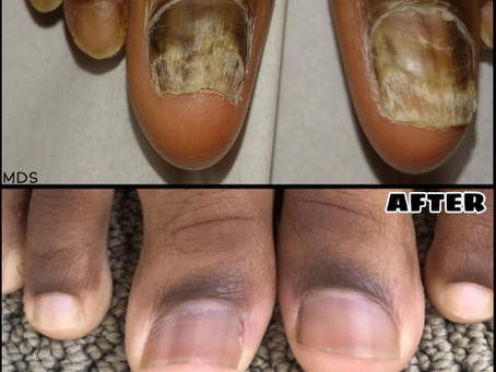 What Things to Consider for Toenail Fungus Treatment in London  