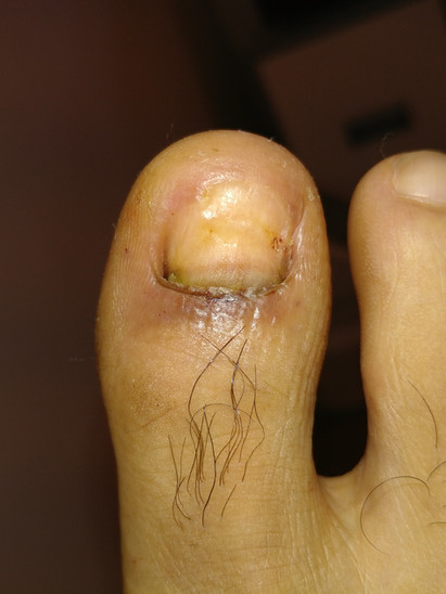 Green Nail pseudomonas Harley Medical Foot and Nail Clinic Nail Surgery Specialist after 3