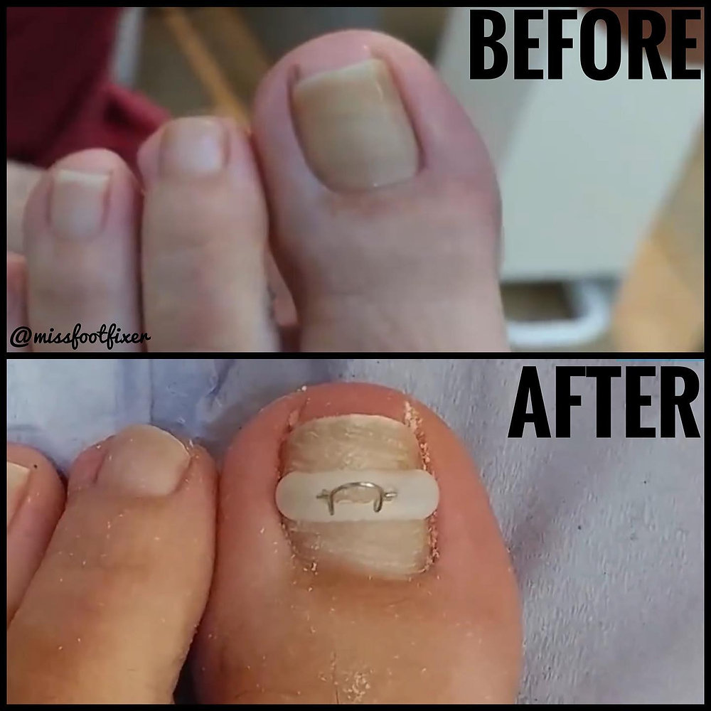 Advantages of Getting Laser Fungal Nail Treatment in London?