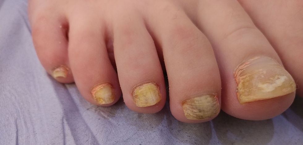 fungal toenail treatment