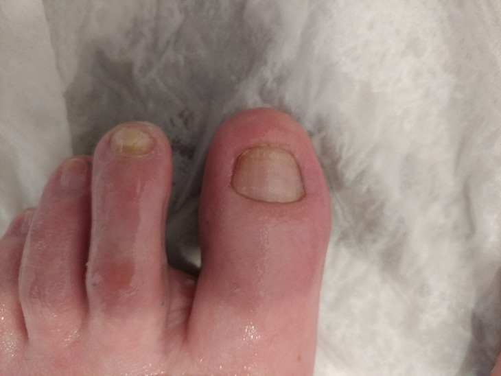 Pseudomonas Green Nail Nail Surgery after 2.jpg