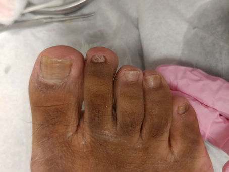 What to Expect from Toenail Removal Surgery in London