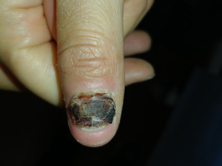 Laser Fungal Nail Treatment in London: Podiatry At Its Best
