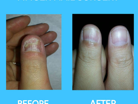 Is Nail Surgery Right for You? Discover the Benefits in London