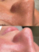 MICRONEEDLING